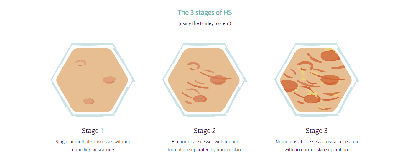 Hidradenitis Suppurativa Stages