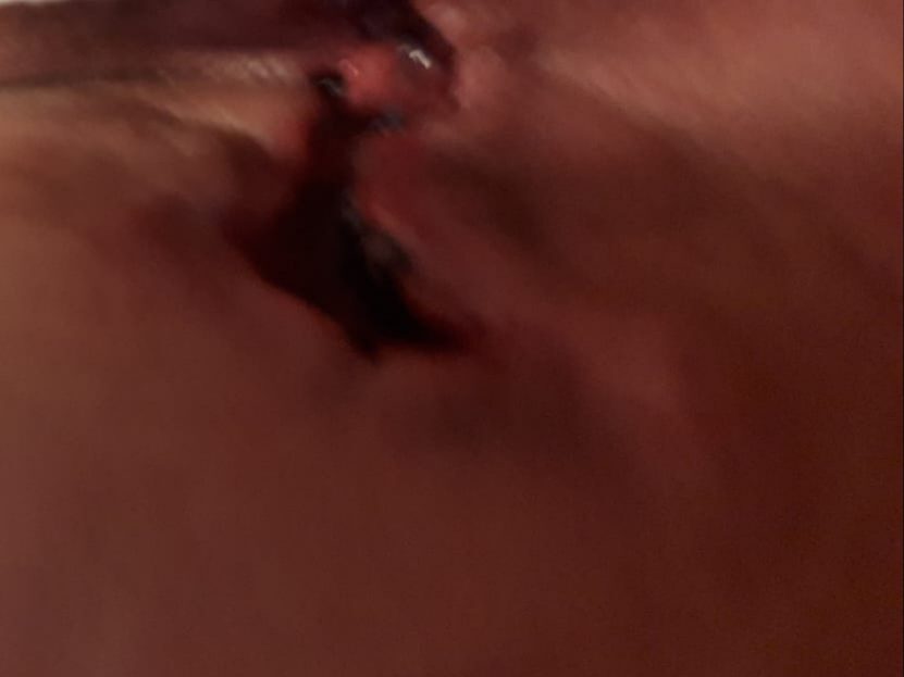 open hidradenitis suppurativa wound care
