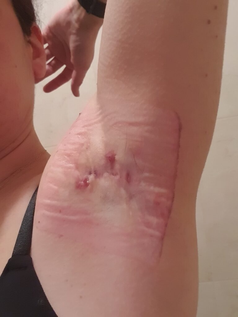 MARSI (medical adhesive related skin injury) in the armpit, common with adhesive hidradenitis suppurativa dressings