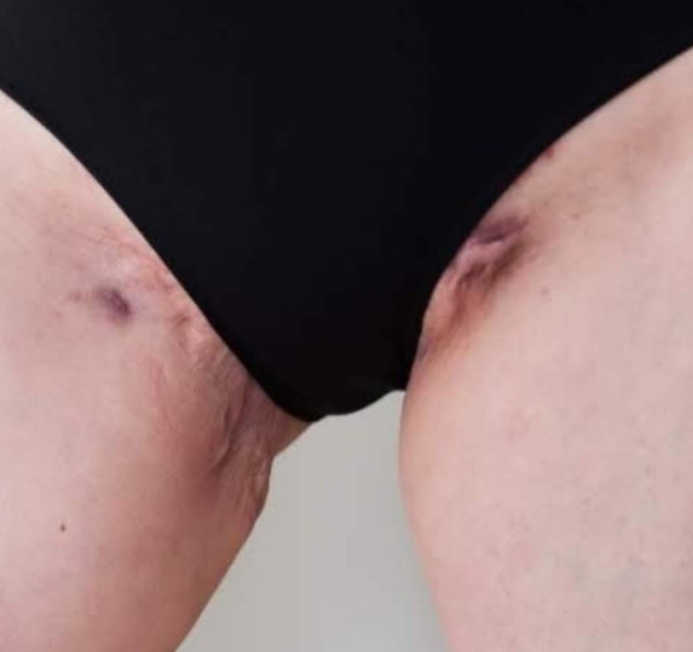 Hidradenitis suppurativa wounds in the groin and inner thighs